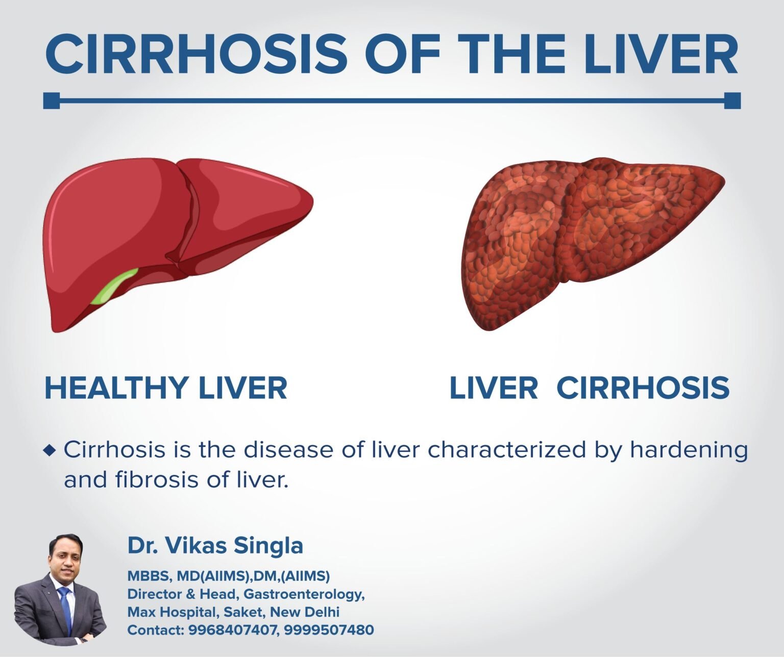 Cirrhosis: Causes, Symptoms & Treatments - Gastron