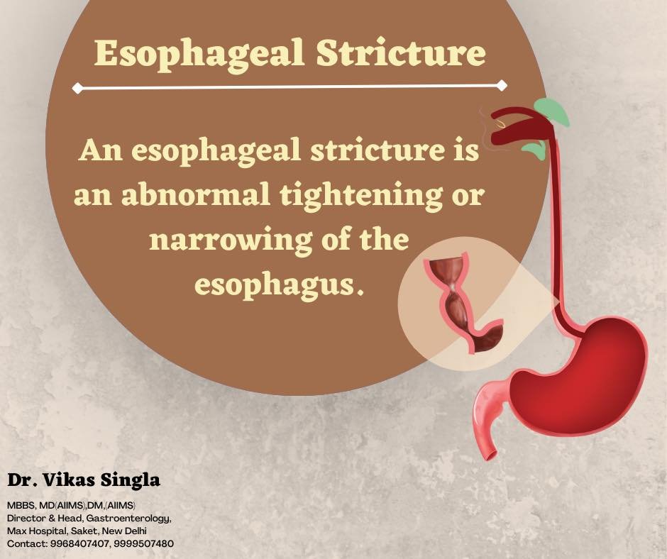 Esophageal Stricture
